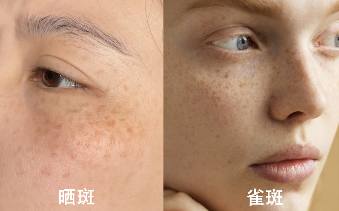 曬斑的預(yù)防與治療