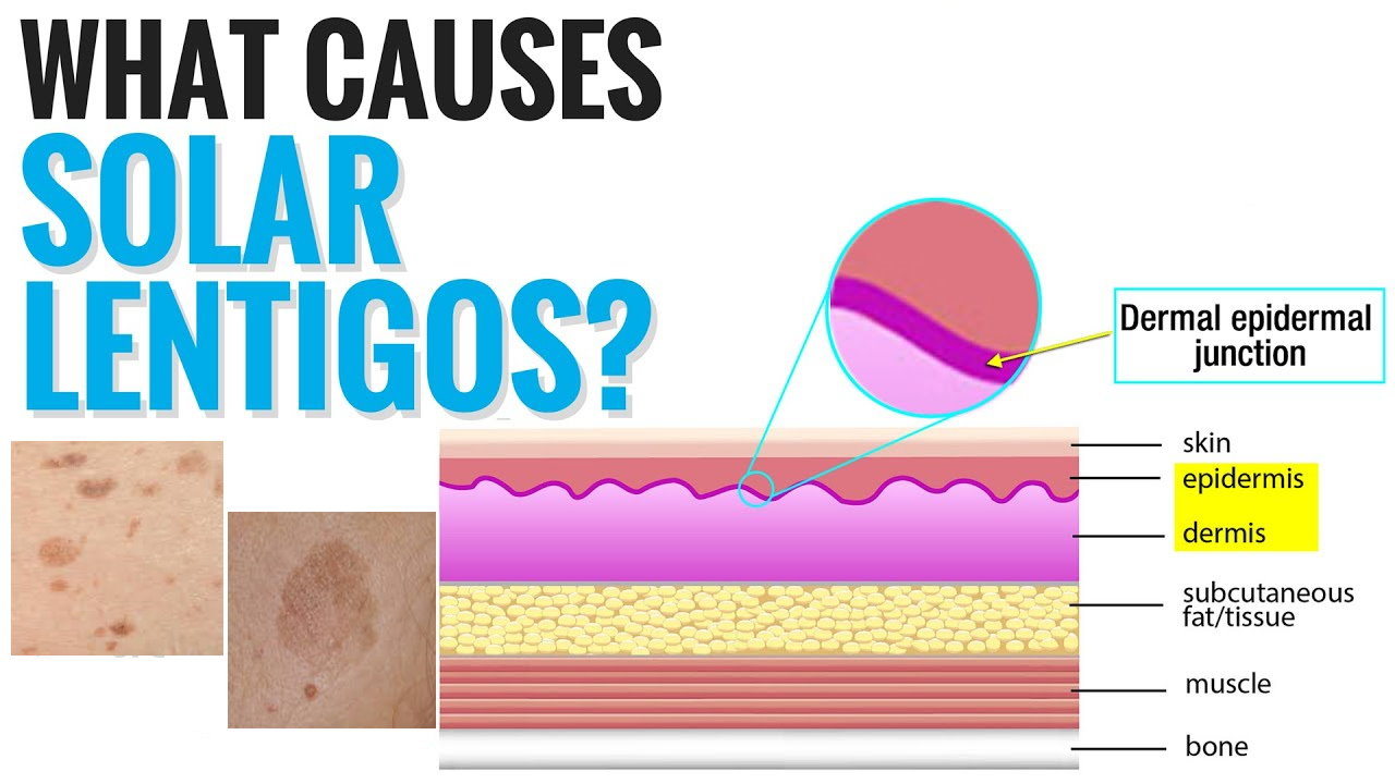 孚美達(dá)“氟輕松氫醌維A酸乳膏”能用于老年斑治療嗎？