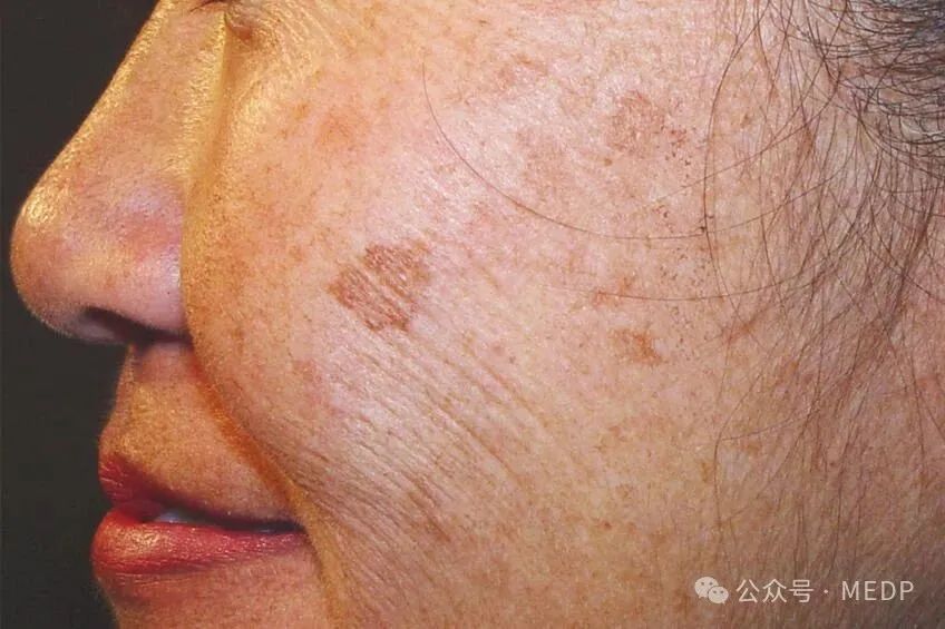 老年斑、曬斑、日光性雀斑是一回事嗎？